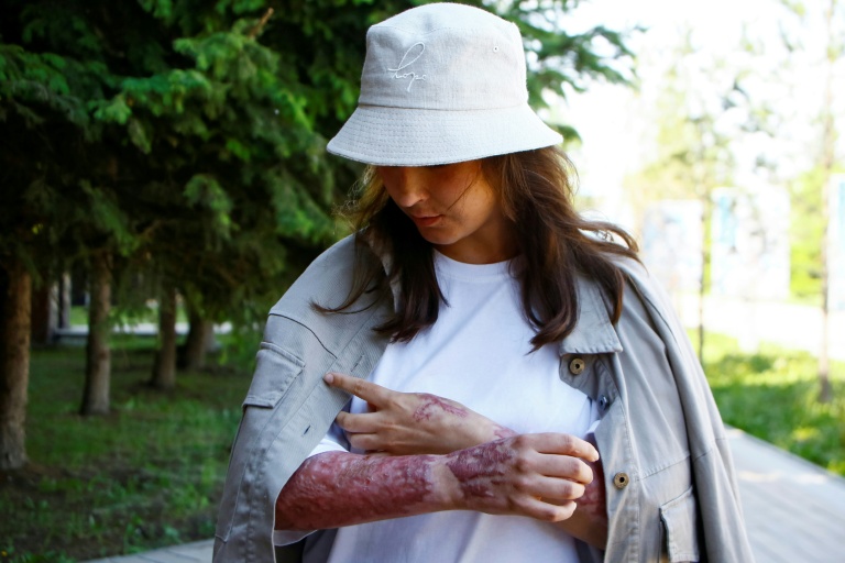 Zarina Guiyassova, survivante de l'explosion de gaz survenue dans un restaurant de Chtchoutchinsk, lors d'un entretien avec l'AFP, le 27 mai 2026 au Kazakhstan
