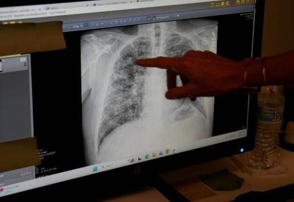 Lisa Emery, directrice du Breathing Center and Black Lung Clinic; montre une radiographie des poumons d'un mineur de charbon souffrant de pneumoconiose, le 13 août 2026 au New River Health, à Oak Hill, en Virginie-Occidentale 