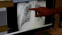 Lisa Emery, directrice du Breathing Center and Black Lung Clinic; montre une radiographie des poumons d'un mineur de charbon souffrant de pneumoconiose, le 13 août 2026 au New River Health, à Oak Hill, en Virginie-Occidentale 