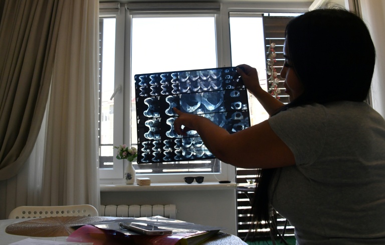 Diana Tergenbaïeva, victime d'une opération ratée de chirurgie esthétique, montre une IRM lors d'un entretien avec l'AFP à Bichkek, le 15 mai 2026 au Kirghizstan