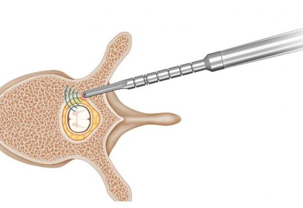 SpineGuard : nouveau brevet américain